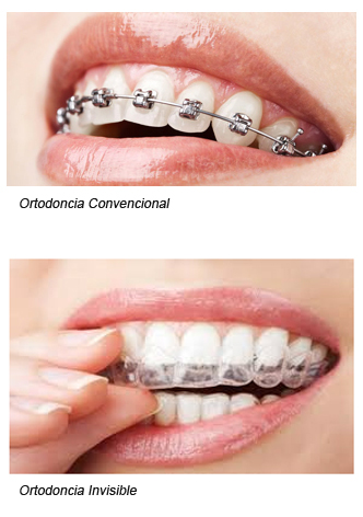 Tipos de Ortodoncias