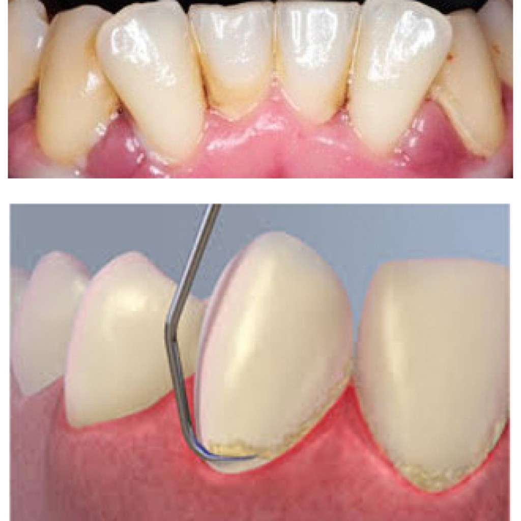 Periodoncia