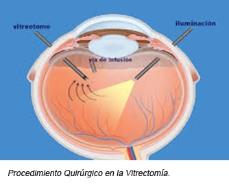 Vitrectomía