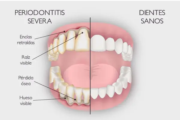 Periodoncia periodontitis severa